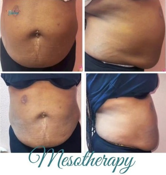 Lipo Dissolve